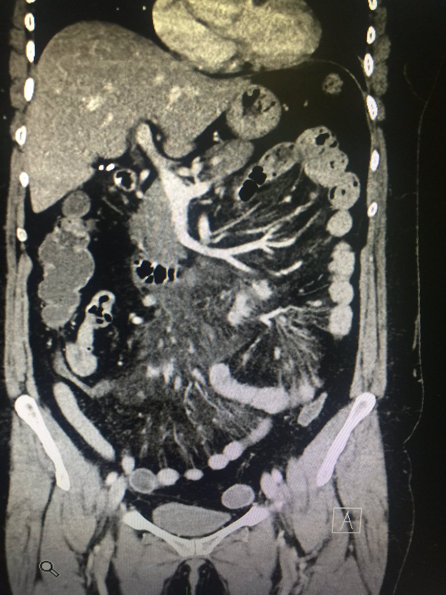 cristianglezMUE's tweet photo. Paniculitis mesenterica, DX poco frecuente en Urgencias. Generalmente alta precoz, pero tiene una variada etiología (Neo,Autoinmune,Infeccioso, etc), por lo que requiere SIEMPRE❗️seguimiento . @MUE_14 https://t.co/zWXCB8GFCB