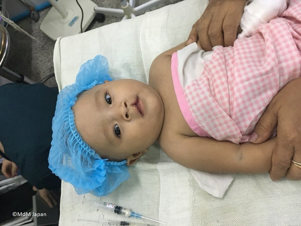 世界の医療団 در توییتر スマイル作戦ミャンマーミッション スタート マンダレーに到着 病院に直行し 74名の術前診察を行いました 形成外科手術が必要な患者さんたちに手術を行っていきます 最初の手術は5ヶ月の女の子 口唇裂の手術です スマイル作戦について