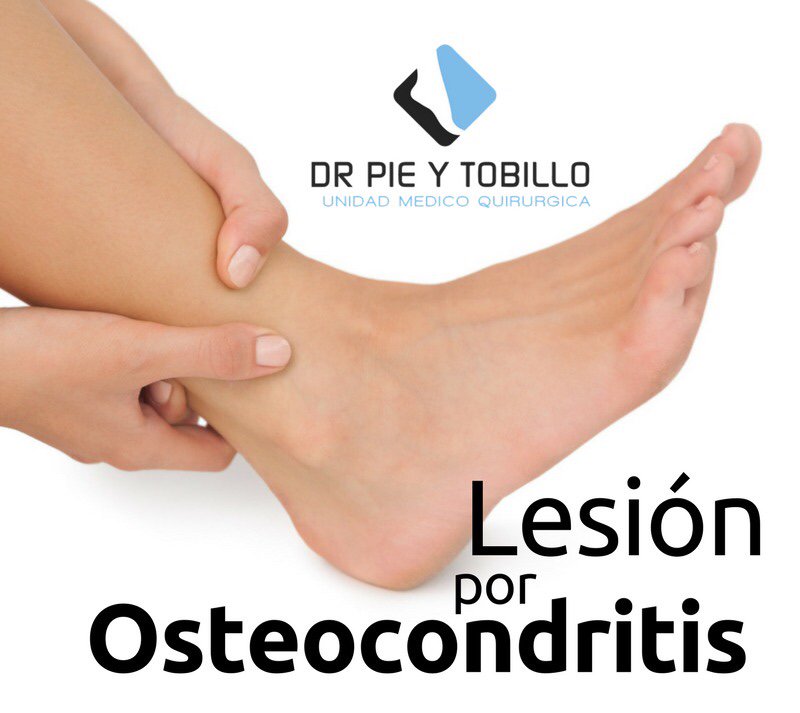 #LesionesOsteocondrales || Consisten en el desprendimiento de un trozo de cartílago dentro de la articulación, en este caso el tobiillo.

#FelizMartes #drpieytobillo #Lesiones #tobillo #traumatology #cirugiaambulatoria #cuerpohumano #partesdelcuerpo #consultamedica