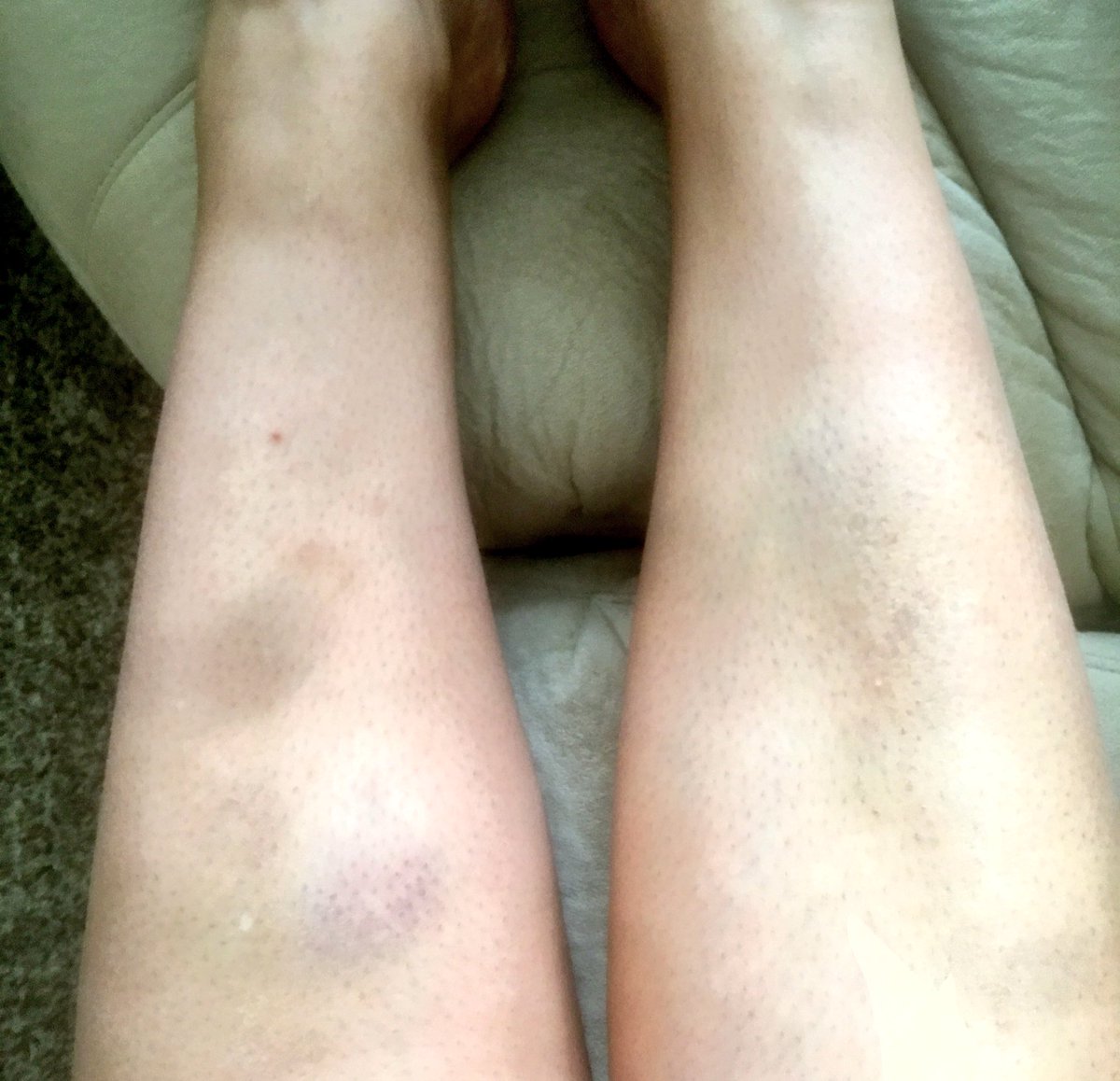 isita_novacek21's tweet photo. Them: what makes you special, unique?

Me: I fall like no ones watching and bruise like no other 

#notchasingwaterfalls #chasingkids #thatbenchcameoutofnowhere https://t.co/5CLBovwkZD