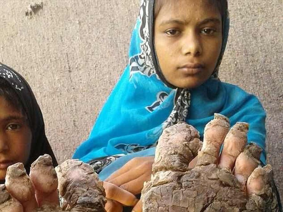 4 Bersaudara yang Tangan Kakinya 'Membatu' Akibat Penyakit Langka detik.id/6HRR10 via <a href="/detikHealth/">detikHealth</a>