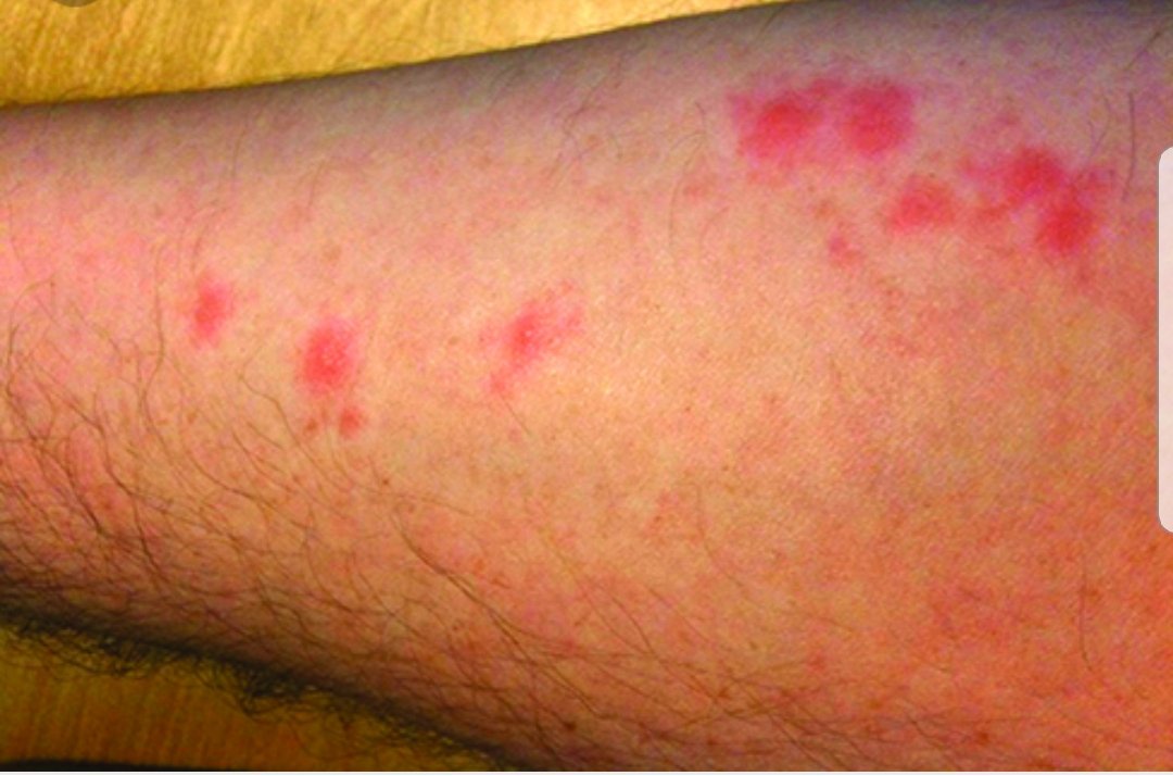 CPC_PEST's tweet photo. Got a call today regarding insects bites. #bedbugs #bitinginsects #pestcontrol https://t.co/GeeOVK6d4X