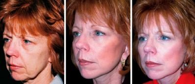 Which Non-Surgical Facelift Technique To Decide On? Ever Thought About Facial Training Training? goo.gl/lWDvf