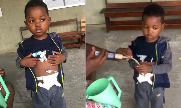 Little Varney needs urgent help. He took in #SodiumHydroxide #NaOH #CausticSoda and is now suffering the aftermath. @GARZEAWU @FPAfrica @DrNyan77 @BeulahNyon @TeceeBoley @stangog @NathanPatio @WHO @SavetheChildren @ChildrensRights @speranskyfund  frontpageafricaonline.com/uncategorized/…