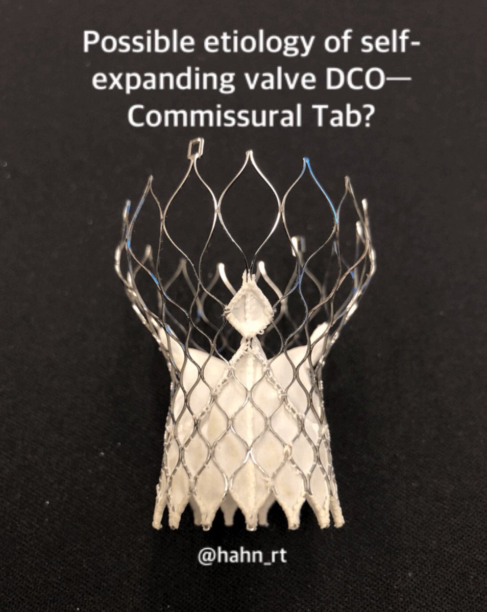 Study showing delayed coronary obstruction(DCO) post- #TAVR of low incidence but overall in-hospital death rate=50%, higher if DCO ≤7 days from TAVR. Clinicians should have a low threshold for performing #coronary #angiography when clinically suspected. sciencedirect.com/science/articl…
