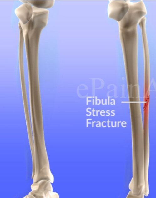 fibula-stress-fracture
