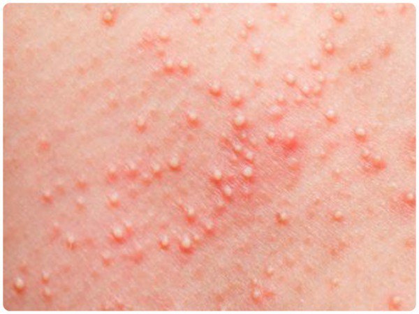 #медицина: Что такое солнечный герпес? опубликована на Pro-Herpes.ru - pro-herpes.ru/labialnyj-gerp…