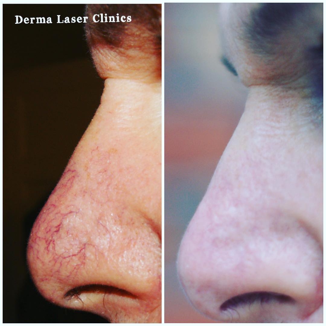 DermaLaserC's tweet photo. Thread Vein Removal Results @Sterex_  #Electrolysis #results #worthing https://t.co/HxMMPw0jKW