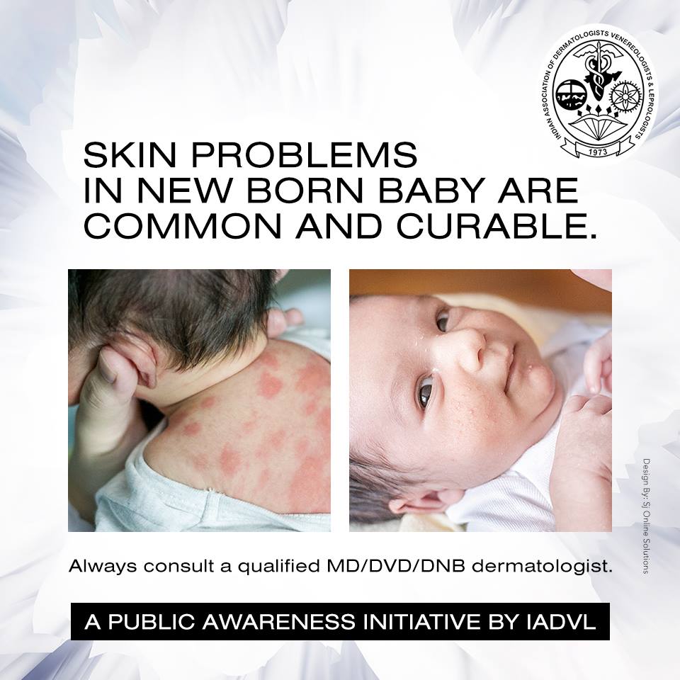 Your newborn baby's skin is sensitive and is prone to rashes of all sorts. Fortunately, most of these rashes are harmless and can be treated with gentle care.

Always consult a qualified dermatologist. 
#IADVLSkin #Newborn #BabySkin #SensitiveSkin