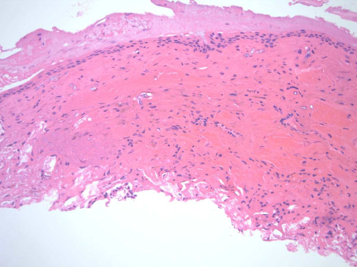 ktmontone's tweet photo. Sinonasal biopsy in immunosuppressed neutropenic patient - low power hemorrhage; high power look for fungus! https://t.co/Z3owjkXX47