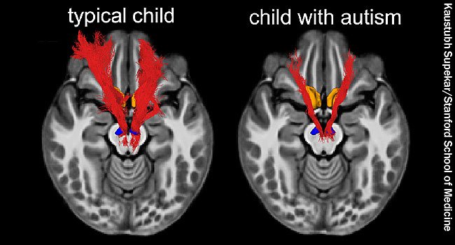 WebMD's tweet image. Using MRI brain scans, a new study found that kids with autism showed differences in the structure and function of a brain circuit called the mesolimbic reward pathway. wb.md/2uyrJhf