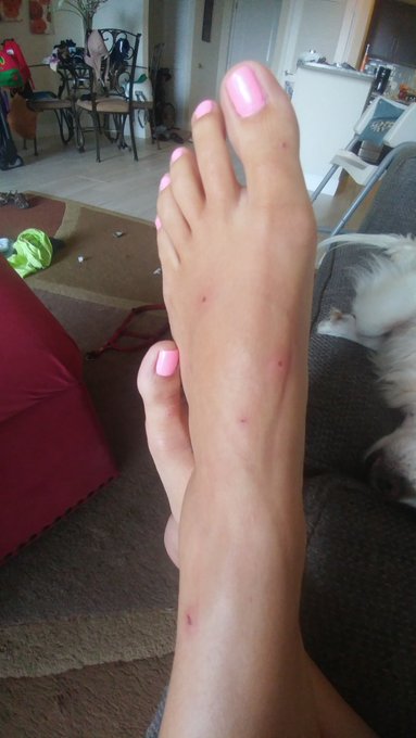 I stepped in fire ants and now my pretty feet look they have the chicken pox😭 https://t.co/RYpZotOO2<a href="/tag/momcomesfirst"class="tags"><span>#momcomesfirst</span></a>