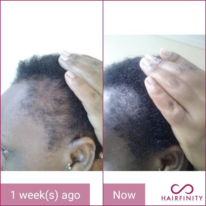 hairfinity's tweet photo. "One week ago. Just been using only the vitamins. Surprised at how much difference I have seen. Just vitamins!!! I’m happy I made this decision to look after my hair! Even my hair feels softer and shiny." - Bae

Read hundreds of testimonials at: https://t.co/CAM1isKWRn https://t.co/nv69gLOX5n
