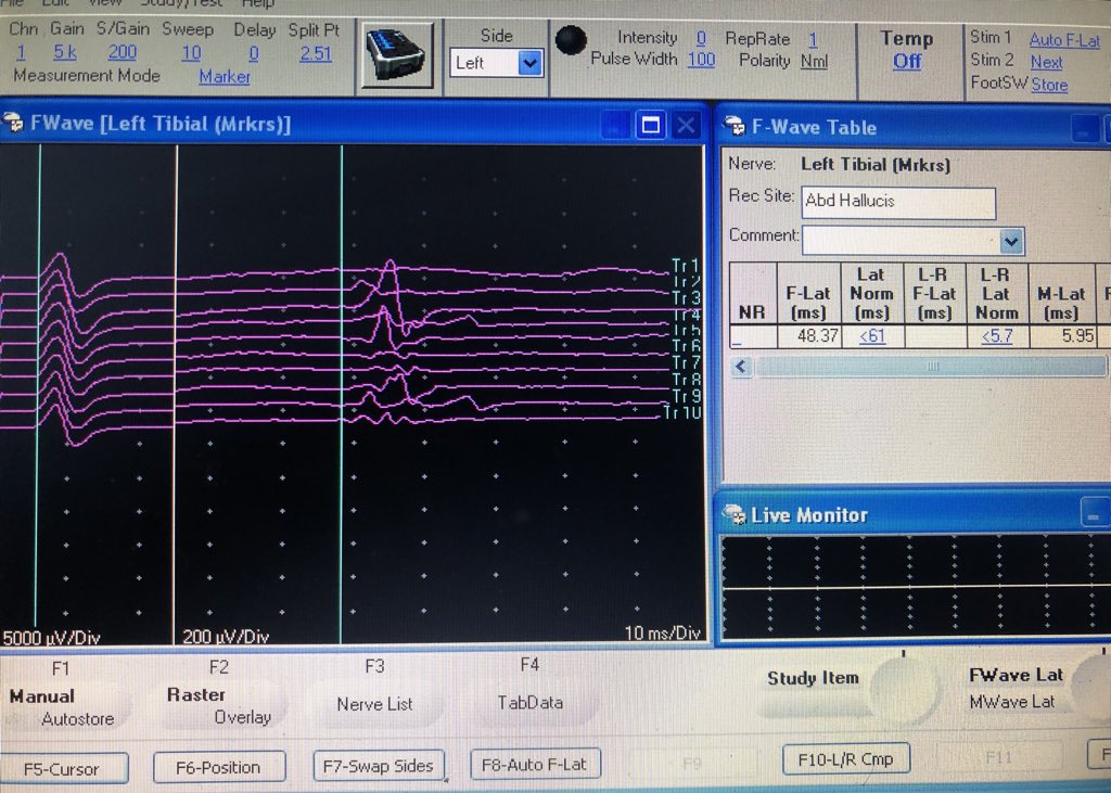 #OndaF #Fwave Neuroconducción: Onda F de Nervio Tibial