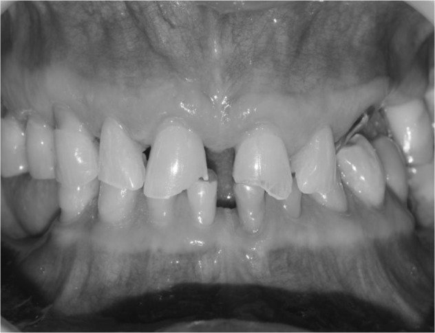 terapiamanualUE's tweet image. #BRUXISMO: #MASAJE + #FÉRULA NO CAMBIA LA #ELECTROMIOGRAFÍA DEL #MASETERO Y #TEMPORAL chiromt.biomedcentral.com/articles/10.11…