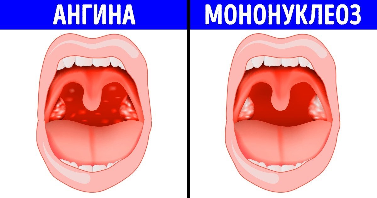 результат горло при мононуклеозе картинки шкафы довольно