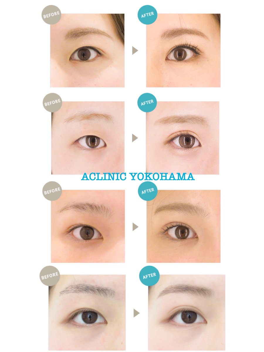 A Clinic 横浜 美容外科 美容皮膚科 スキンケアのaクリニック 綺麗な二重 になりたい 自然な二重 になりたい 二重の幅 を広げたい など なんでもご相談下さい 皆様のご予約お待ちしております 045 594 6440 お得な情報