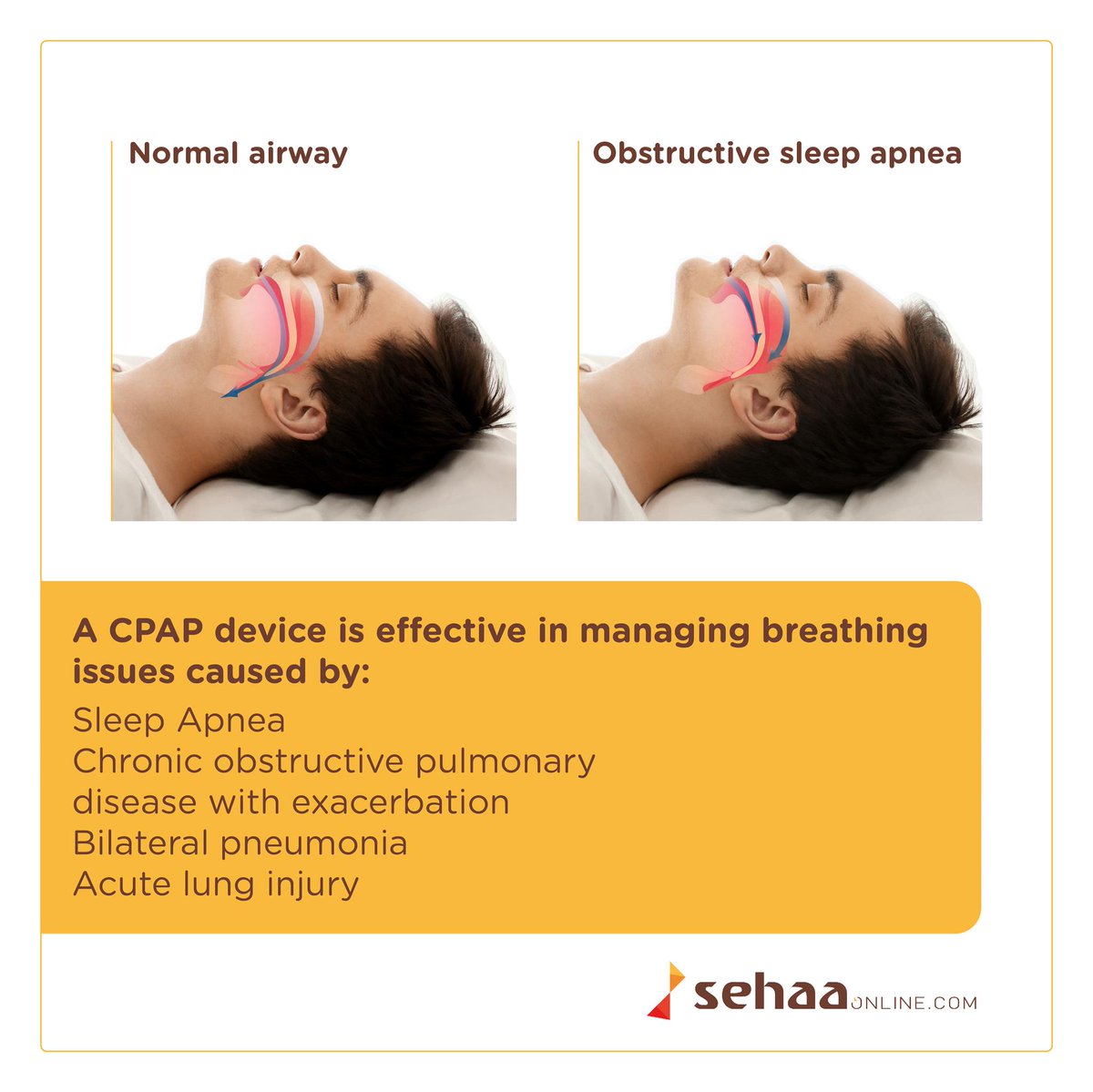 sehaaonline's tweet image. CPAP devices r effective treatment options 4 ppl who experience breathing problems,most common being obstructive sleep apnea.Find d right device ow.ly/e0Hg30kQovG 
#sehaaonline #cpap #cpapdevice #sleepapnea #bilateralpneumonia #lunginjury #breathingproblems #respiratorycare