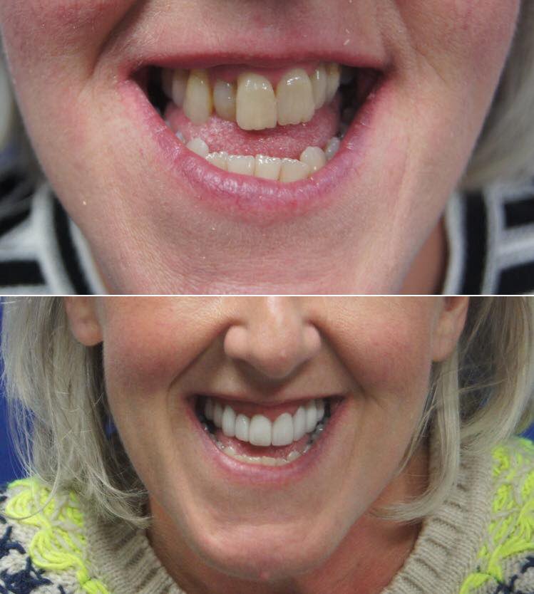 Some more fantastic before and after photos from one of our patients

Look how cosmetic dentistry can help give you the smile you’ve always wanted 

Call 01512860330 now to book your consultation 

#crosbydental #dentistliverpool #cosmeticdentistry