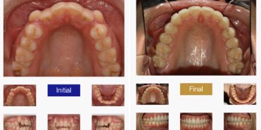 clinicabio's tweet photo. Discover the Teen Invisalign option through Dr. Kamy Malekian's case #422!
View full treatment: https://t.co/PksOb6bI1t

Don't miss out on 15% off K&amp;K Diamond Master Class 26-27th October in Barcelona!

Sign up here: https://t.co/TR32dSxkN3
More info at: https://t.co/zTw2yDGDyi https://t.co/GFlhLa1rBW