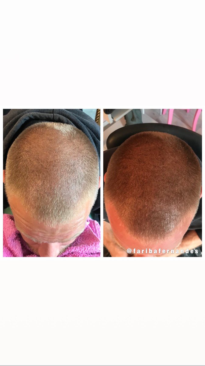 FaribaSilva's tweet image. #scalppigmentation #hairloss #solution #folikel #mikrohaarpigmentation #transformation #men #women