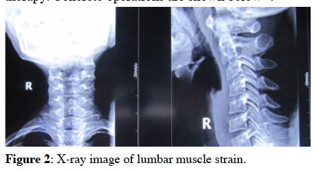 Need to convey poor standard of athlete low back pain published research for a talk. Think this paper does it nicely🤔 Note 'lumbar muscle strain' 🙃 Athletes treated with massage and hot magnets. All got better 💥 Of course they did🤪 Published in 2016 and indexed in Medline