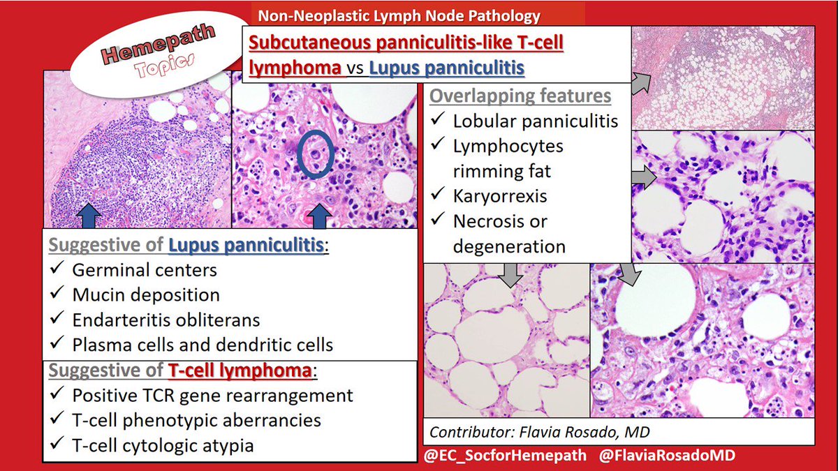 Did you know... ...lupus panniculitis can closely mimic subcutaneous panniculitis-like T-cell lymphoma? Overlapping features and important differences are shown, courtesy of @FlaviaRosadoMD #hemepath #dermpath