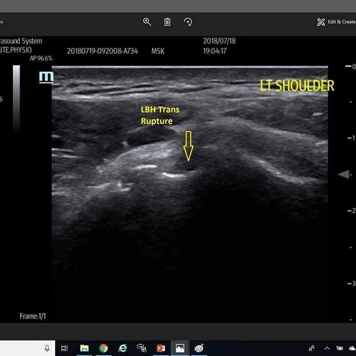 ABSPhysio's tweet photo. Long head biceps rupture picked up by one of our physio's Ben Allen. Patient presented with positive 'popeye' sign&biceps pain.Patrick performed ultrasound scan to confirm rupture with retraction of the tendon. #MSKsonography #PUMUS #ESP #MSKUS https://t.co/bz8e8MKrCq