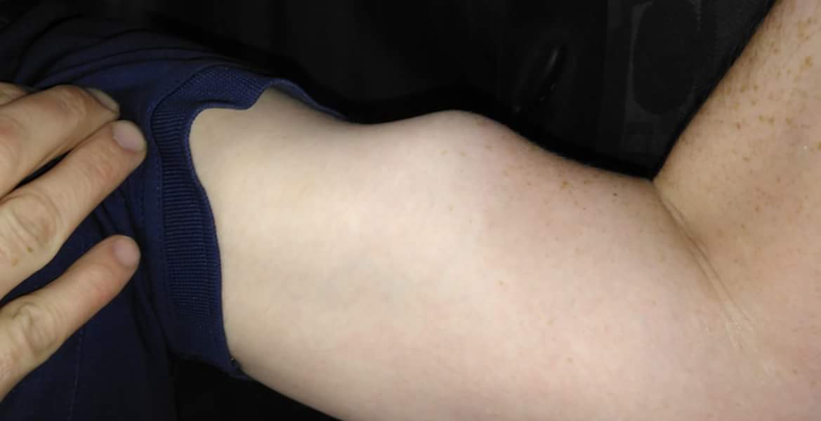ABSPhysio's tweet photo. Long head biceps rupture picked up by one of our physio's Ben Allen. Patient presented with positive 'popeye' sign&biceps pain.Patrick performed ultrasound scan to confirm rupture with retraction of the tendon. #MSKsonography #PUMUS #ESP #MSKUS https://t.co/bz8e8MKrCq