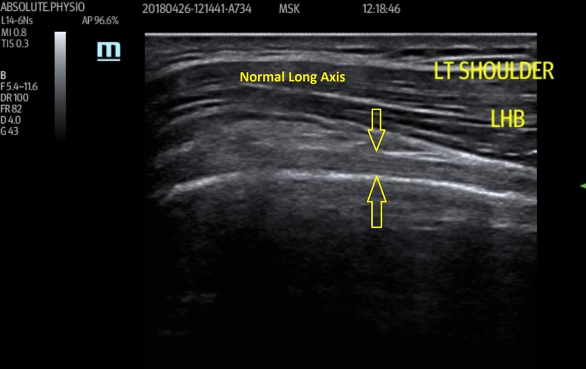 ABSPhysio's tweet photo. Long head biceps rupture picked up by one of our physio's Ben Allen. Patient presented with positive 'popeye' sign&biceps pain.Patrick performed ultrasound scan to confirm rupture with retraction of the tendon. #MSKsonography #PUMUS #ESP #MSKUS https://t.co/bz8e8MKrCq