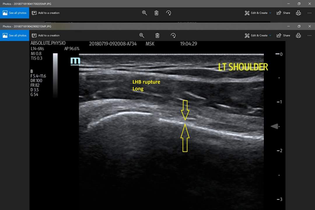 ABSPhysio's tweet photo. Long head biceps rupture picked up by one of our physio's Ben Allen. Patient presented with positive 'popeye' sign&biceps pain.Patrick performed ultrasound scan to confirm rupture with retraction of the tendon. #MSKsonography #PUMUS #ESP #MSKUS https://t.co/bz8e8MKrCq