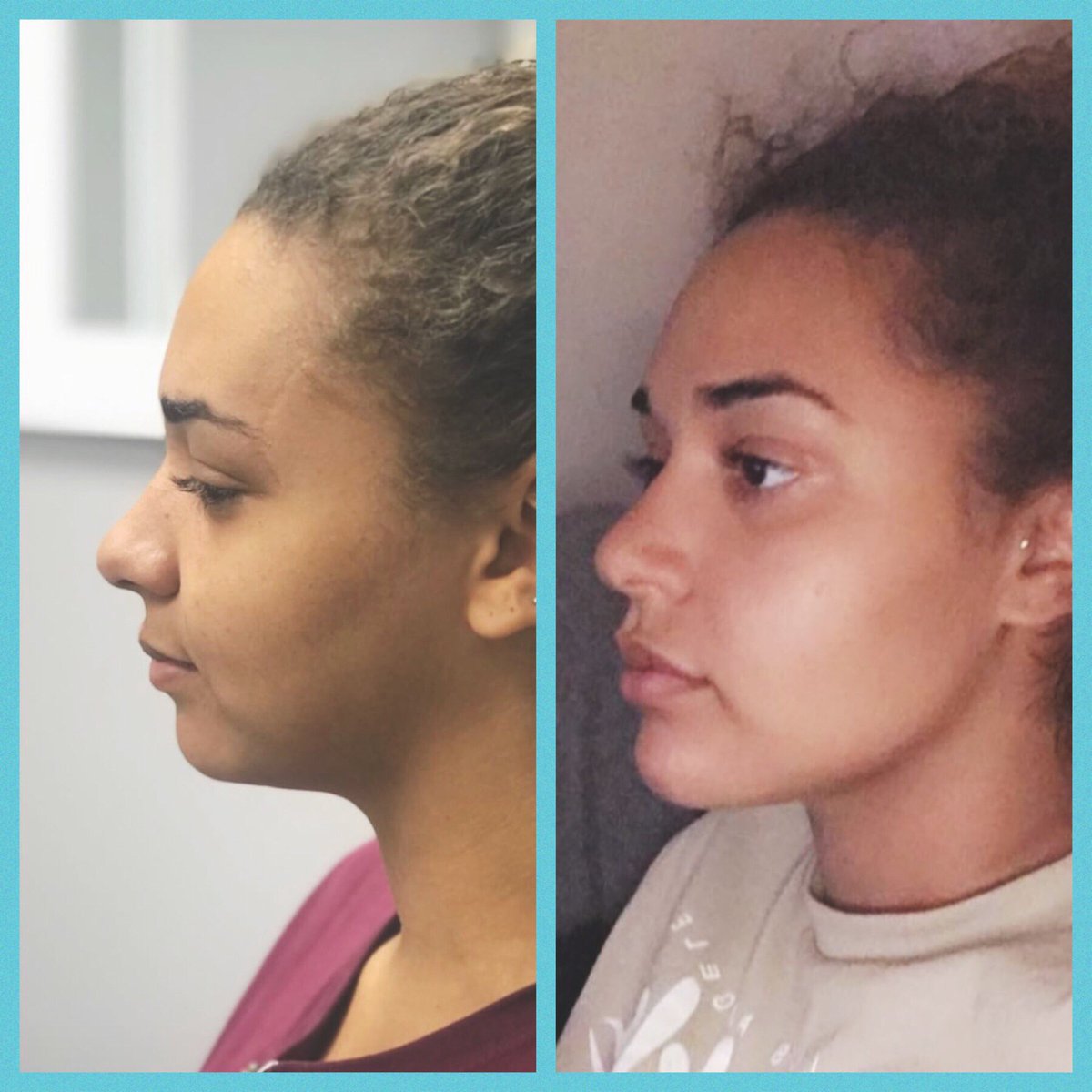 FFaesthetics1's tweet photo. Maybe sheβs born with it, maybe itβs FFA πβ‘οΈ
.
#chinfiller #jawline #columbusaesthetic #columbusohio #faceforwardaesthetics #ffa #plumplips #beautiful #looklikethis #asseenincolumbus https://t.co/WG14PKHumu