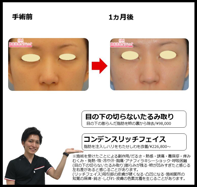 O Xrhsths 湘南美容外科クリニック 浜松院 Sto Twitter こんにちは 本日は 目の下の切らないたるみ取り と コンデンスリッチフェイス を受けられたお客様 目の下の脂肪を除去するだけで 若々しくなりますね たるみ や くま でお悩みの方 井上礎馬dr