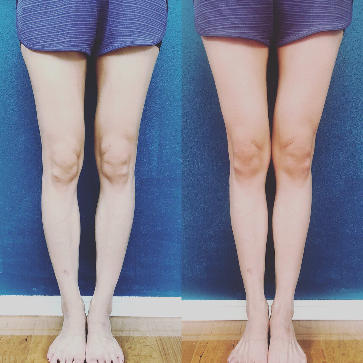 いのトレ Qpu ダイエット 美容垢 O脚改善するとこれだけ見た目が変わる 脚が真っ直ぐになると細く 長く見えるんだよね ワンセッションでの変化なので体重は一切変わっていません