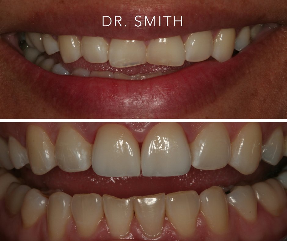 Interested in veneers, but are concerned about how fake the end result could turn out? Look no further! Dr. Smith does beautiful work that looks so natural no one would be able to tell the difference! 

Call us today to schedule your Veneer consultation!