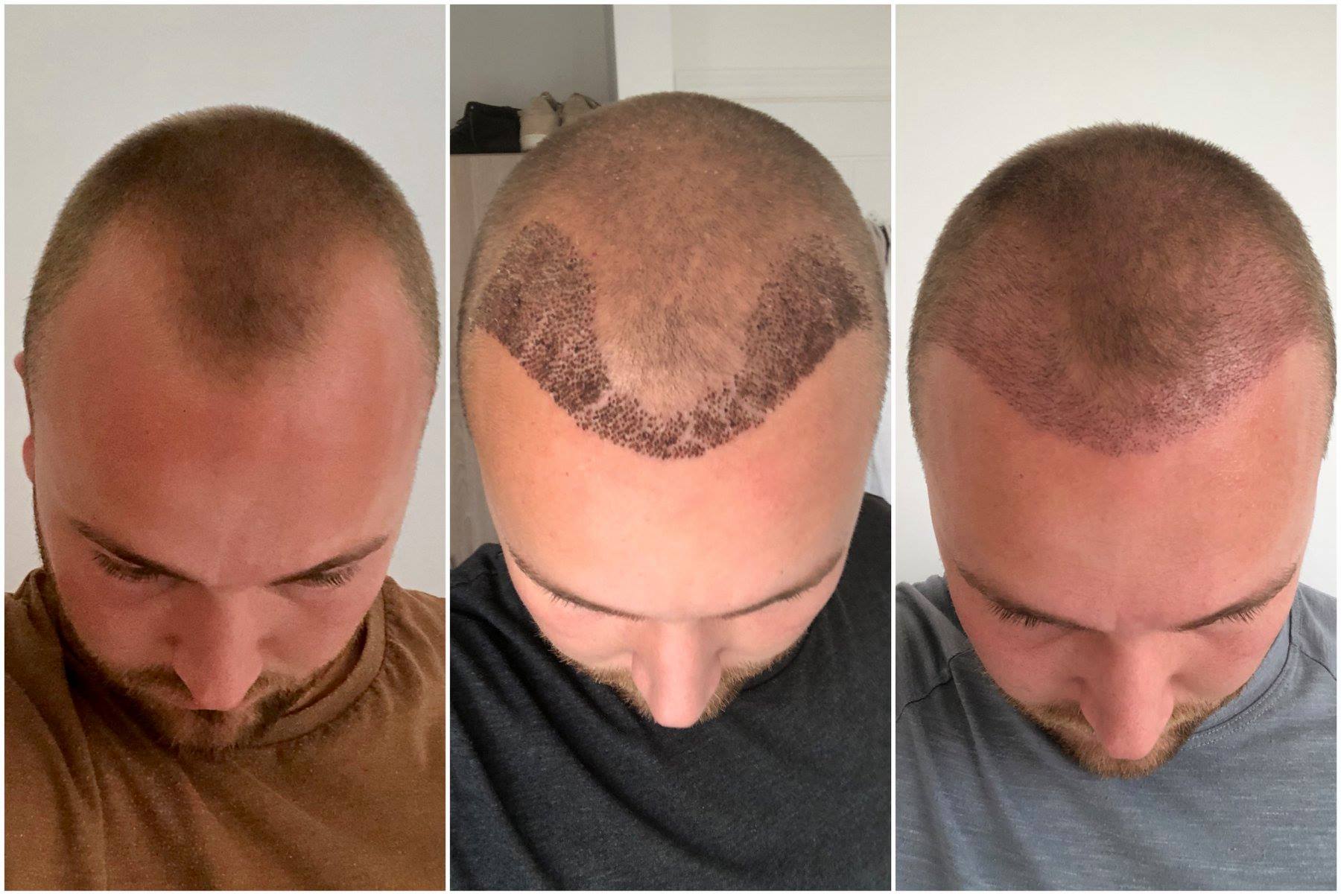 Hair Transplant Journey Hair Transplant After 3 Months  Results