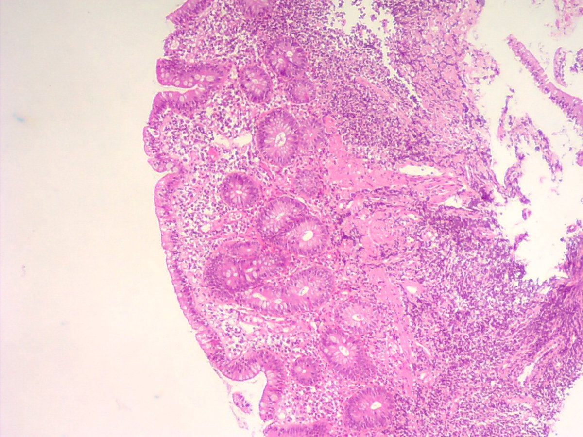 ariella8's tweet photo. @RaulSGonzalezMD Dr Gonzales .What do you you think of this one ? This is the ileal bx. Female on her 60s .Chronic diarrhea .Also with lymphocytic colitis and eosinophilia of mucosa #GIPAT @ariella8
See next pics https://t.co/78Nq7p2PVd