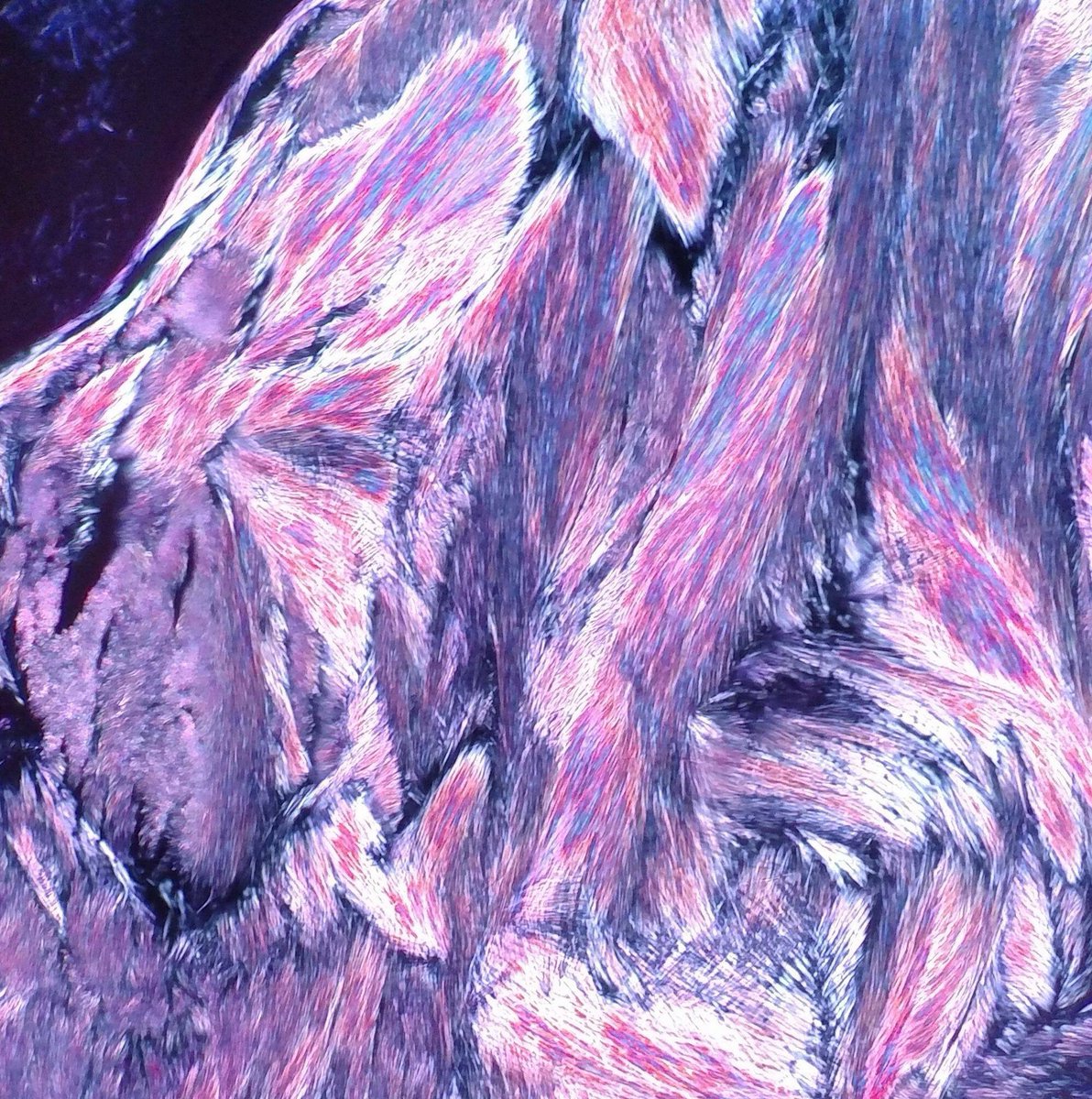 The most beautiful gout picture I have ever seen! From Theresa Smith of #SoMeDocs (lucky picture from a new scope and polarizer on embedded tissue). Ten important facts about gout here: creakyjoints.org/treatment/teng… #pathart <a href="/pathologistmag/">The Pathologist</a> <a href="/Human_Pathology/">Human Pathology</a>