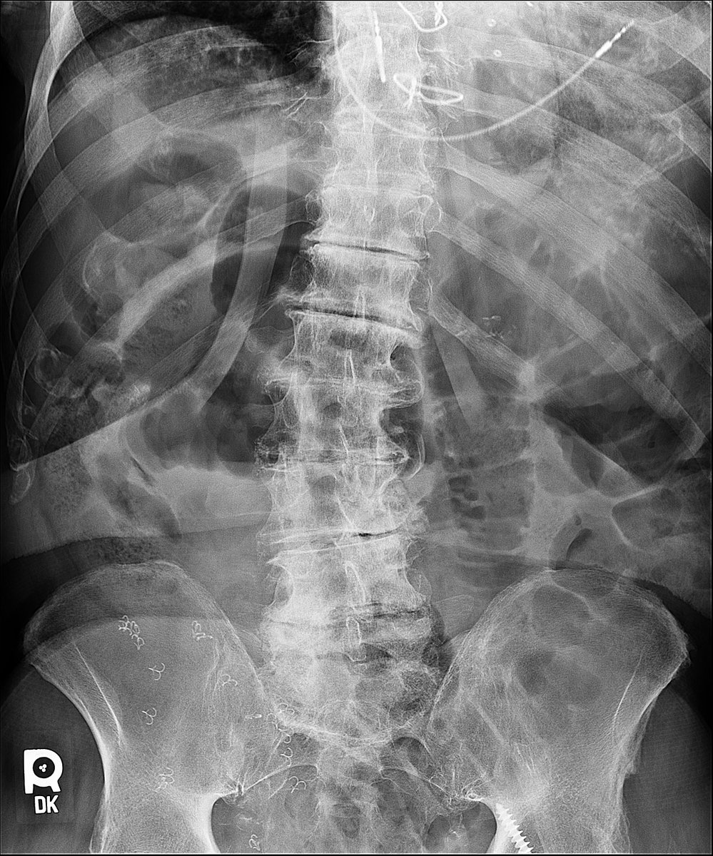 Multiple dilated loops of small bowel with air-fluid levels #SmallBowelObstruction

#radiology #radiologyimages #radpic