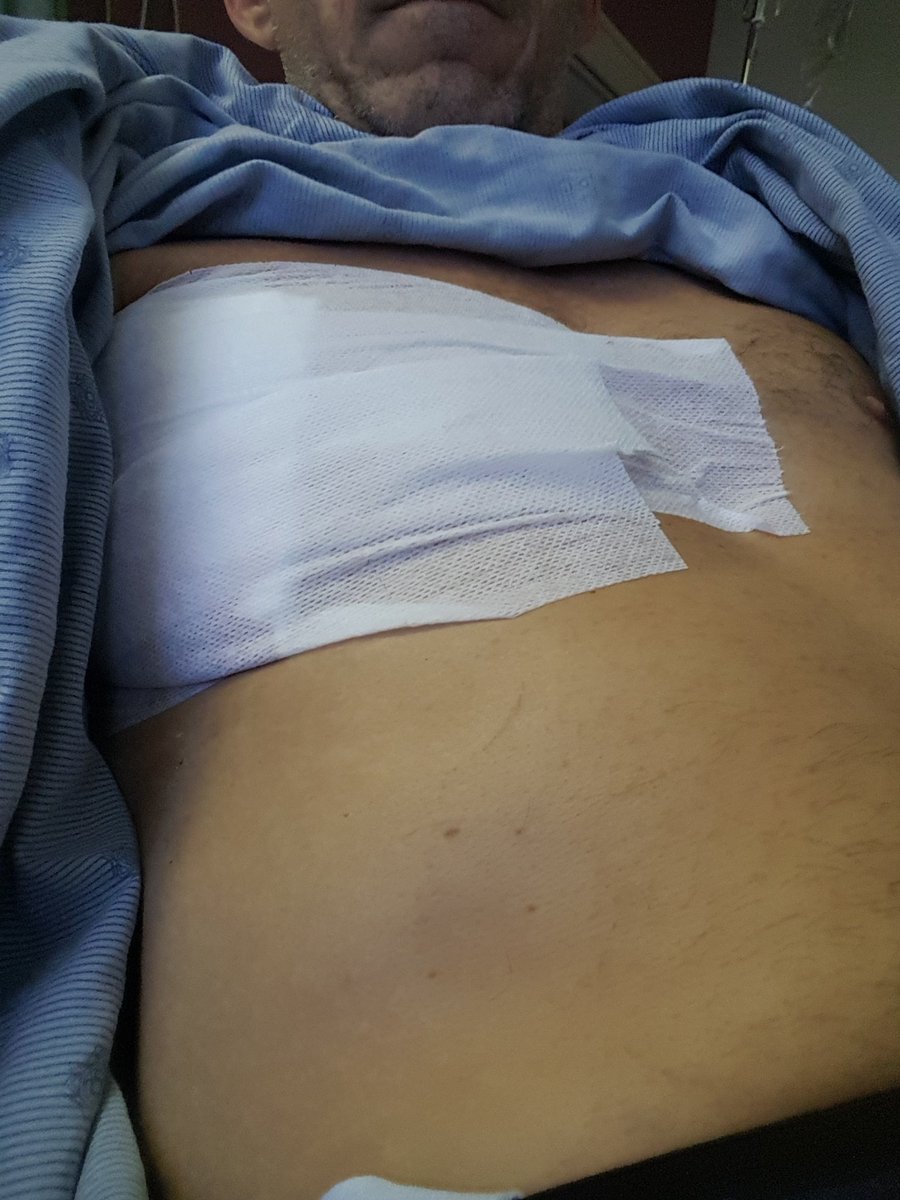 Kissiefer1's tweet photo. This is me, and my update from the #victoriageneralhospital. Chest tube is gone, thank God for that. I have this very nasty bruise, ouch, ouch.
Out & About
#halifaxns https://t.co/5cGTjQNSCP