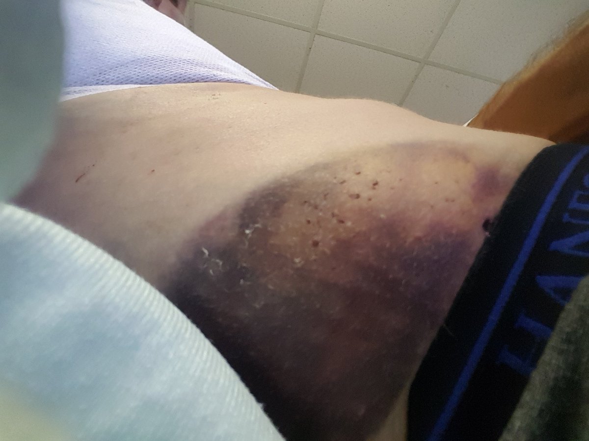 Kissiefer1's tweet photo. This is me, and my update from the #victoriageneralhospital. Chest tube is gone, thank God for that. I have this very nasty bruise, ouch, ouch.
Out & About
#halifaxns https://t.co/5cGTjQNSCP