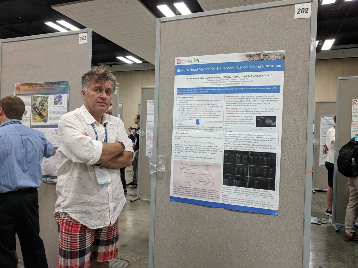 bramachim's tweet photo. .@EBIBristol @EPSRC @VILaboratory Our research poster paper on B-line detection in lung ultrasound @IEEEembs #EMBC2018 @hawaiiconventio https://t.co/1KE12G29Mm