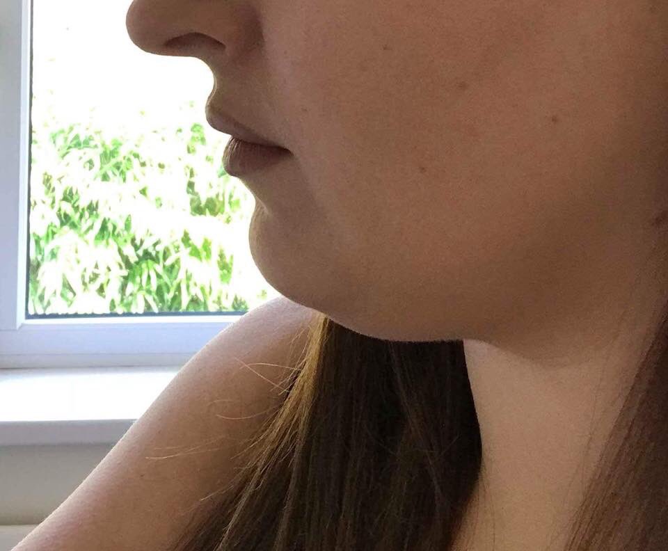 MrIanMorgan's tweet photo. Before and after fat removal and platysma muscle tightening✨ Our client was always bothered by their neck area, this was hereditary within their family.
Contact us for more details: 01543 572838
#fatremoval #platysmamuscletightening #aesthetics #surgery #soulcare https://t.co/qG4LcdFd4c