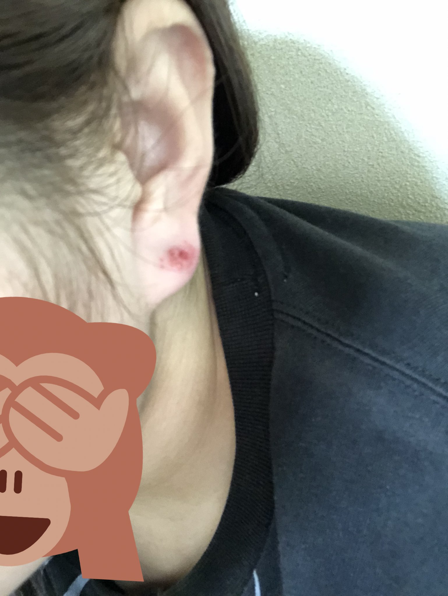 美衣 ໒ ゚ בטוויטר ピアス開けてからすぐ ハート型のピアスにはめかえたら 膿が出てきて固まってのくり返しだったんだけど さっき外したら 赤くただれててピアス外しました ちょっと腫れてるし 同じところにピアス開けたから 穴が広がって余計に痛むし 美衣 ໒ ゚ בטוויטר ピアス開けてからすぐ ハート型のピアスにはめかえたら 膿が出てきて固まってのくり返しだったんだけど さっき外したら 赤くただれててピアス外しました ちょっと腫れてるし 同じところにピアス開けたから 穴が広がって余計に痛むし