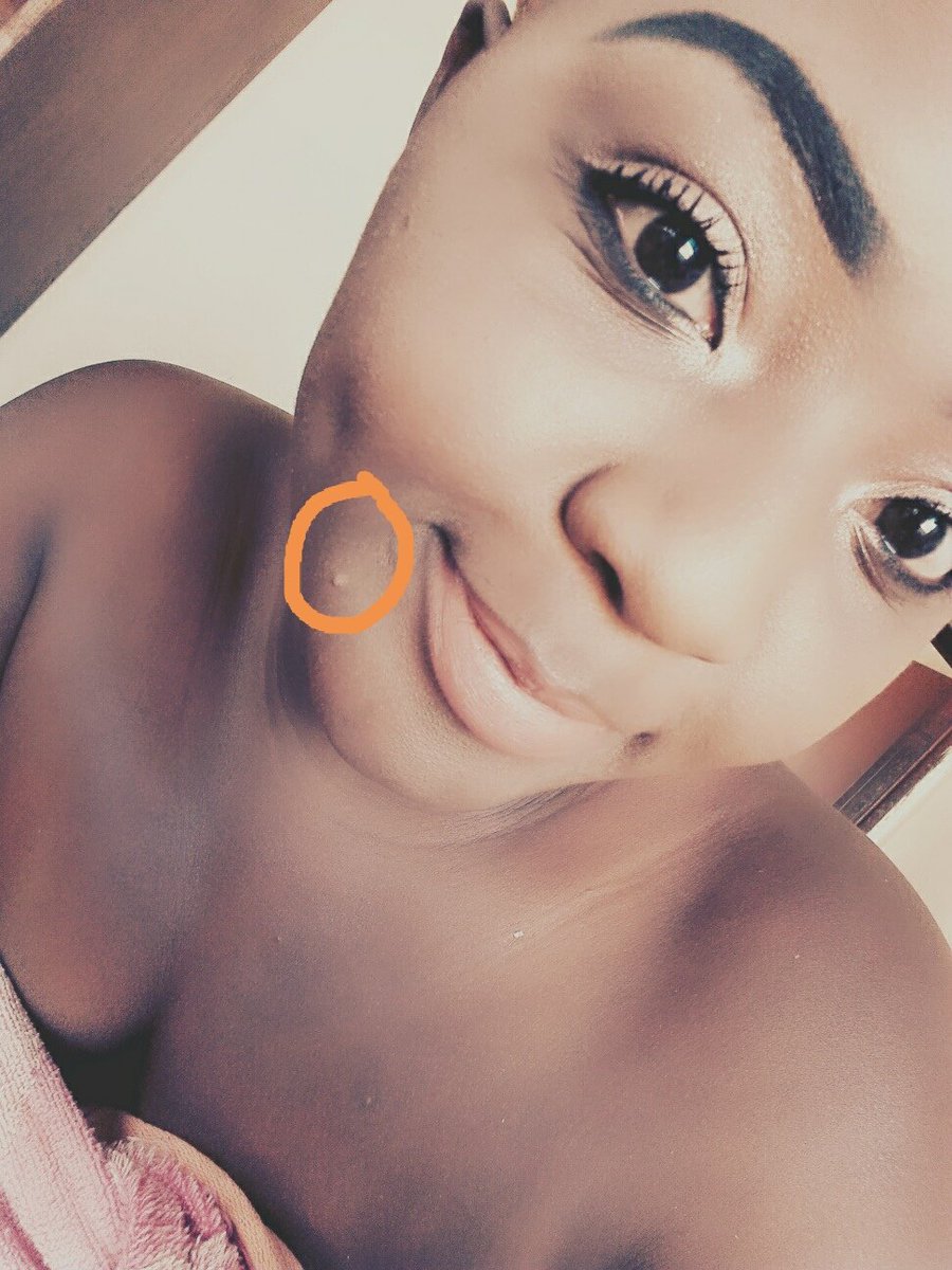 Judy24807240's tweet photo. #Face Ruined😟
#Pimple dou....Smash....
#Saturdae Selfie💗 https://t.co/CiQBvt7Wbm