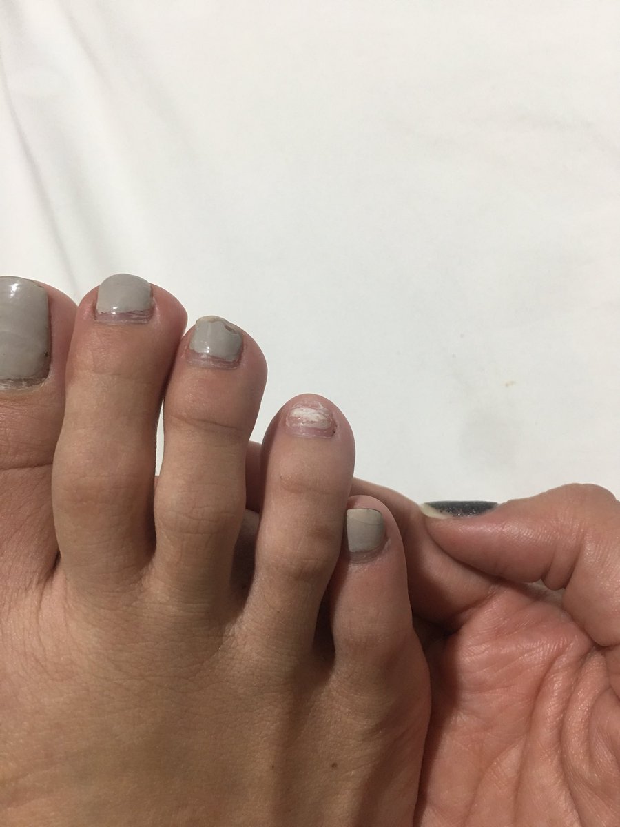 leyasoriano's tweet photo. hanggang san aabot ang buhay ng kuko mo #walkathon #disneyland #mongkok #neveragain #surprise #icanshowyoutheworld #pedicurenomore #ohhindeee #excusemepo #treasureeverymoment #youcannevertell https://t.co/kOh4B7XE6m