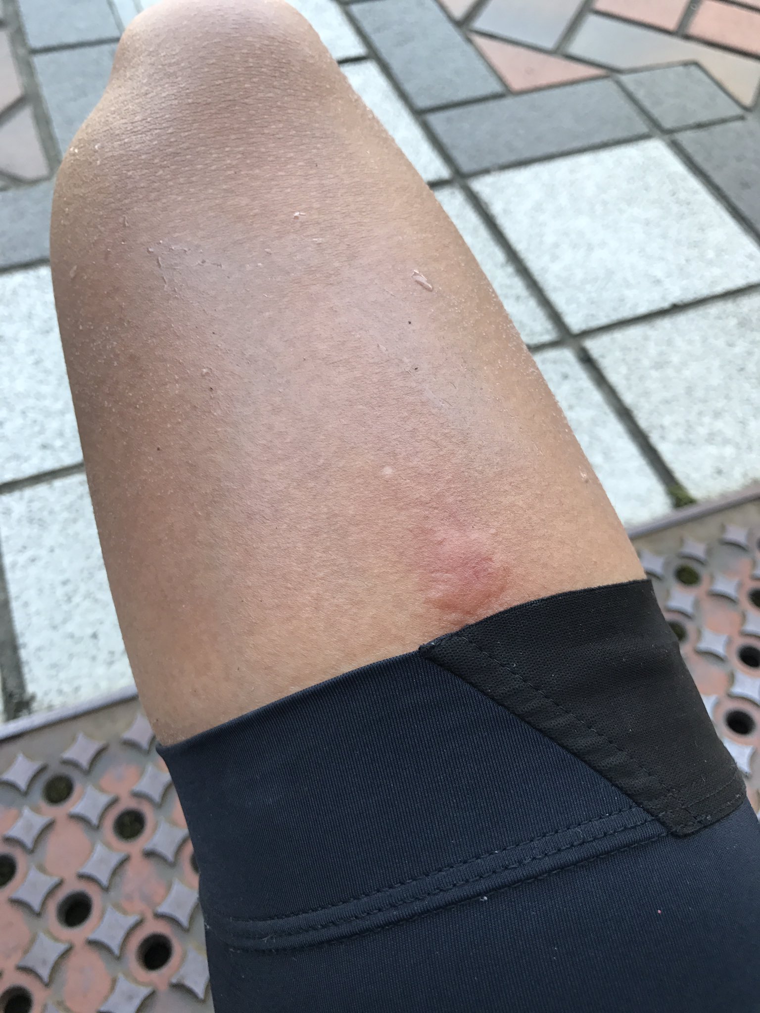 た 跡 刺され アブ