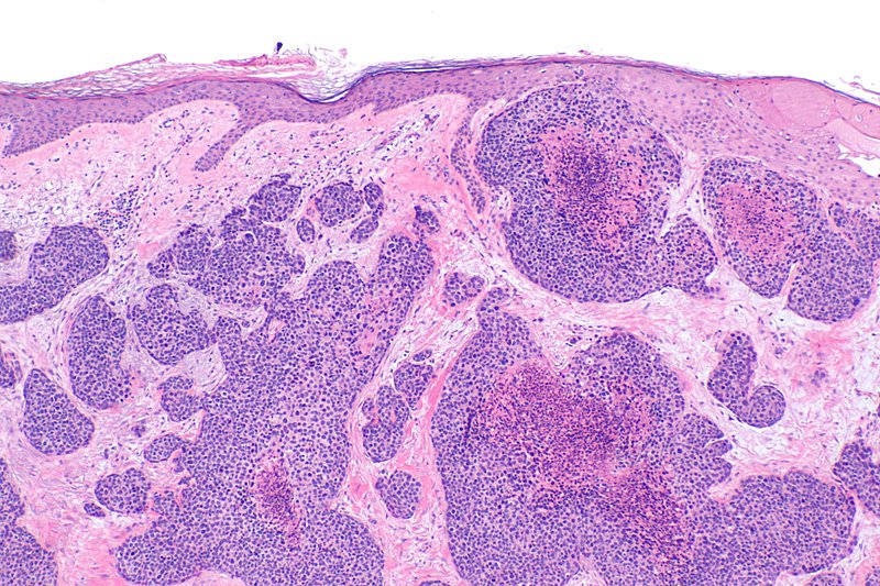 librepathology's tweet photo. We added an article on porocarcinoma recently #dermatopathology #skincancer https://t.co/gr2kbPqR3u