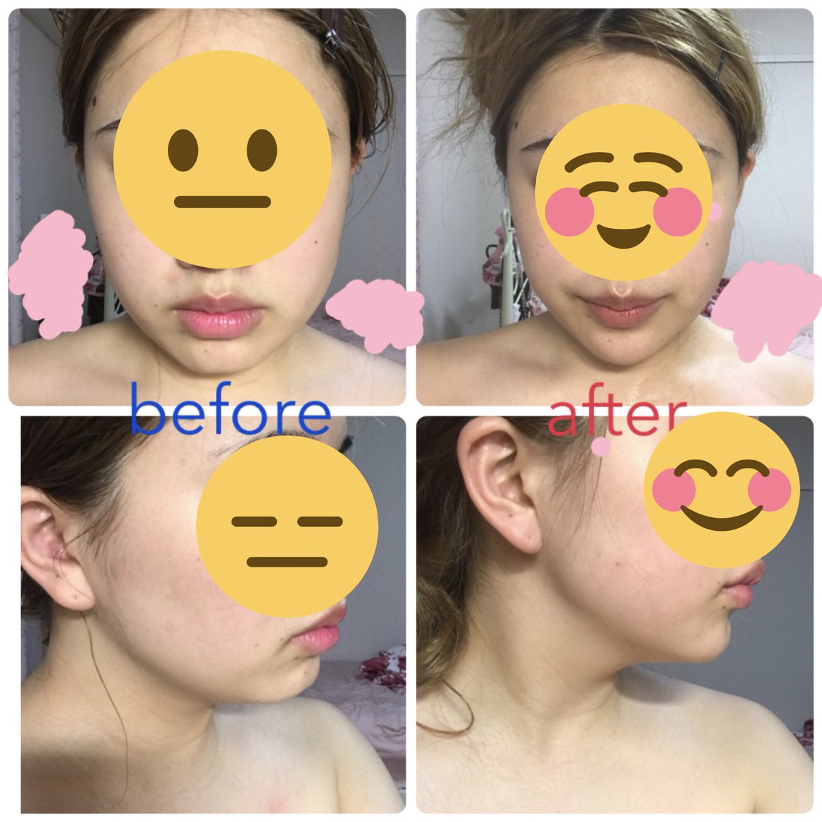 ___beautyz's tweet photo. AOでやったエラボト、輪郭注射、顎ヒアル、口角ボトの効果が凄すぎる〜！！！横顔めっちゃ変わったよ..... 感動😭😭 https://t.co/Cy1wwW2umI