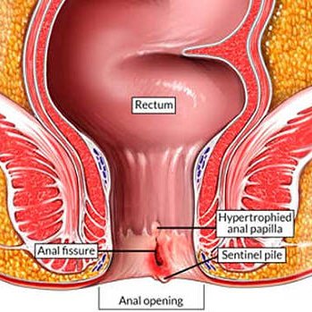 Fissure in anus what Fissure in anus almost same